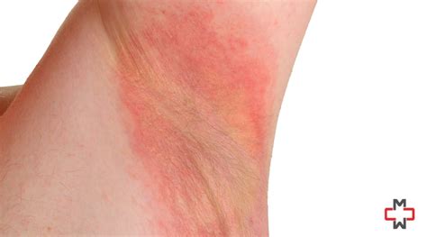 Armpit rash: Causes, treatment, and prevention.